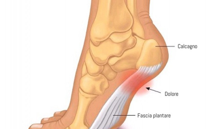 Fascite