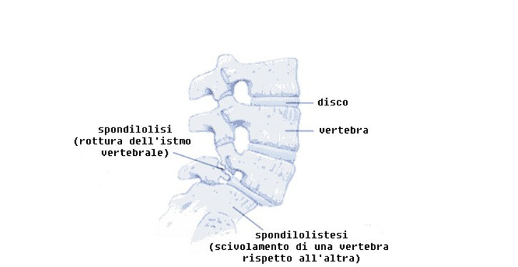 Spondilolistesi istmica