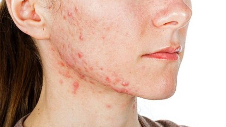 Acne