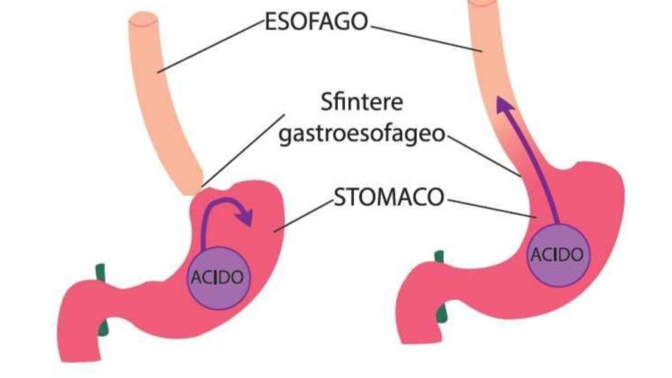Reflusso gastroesofageo