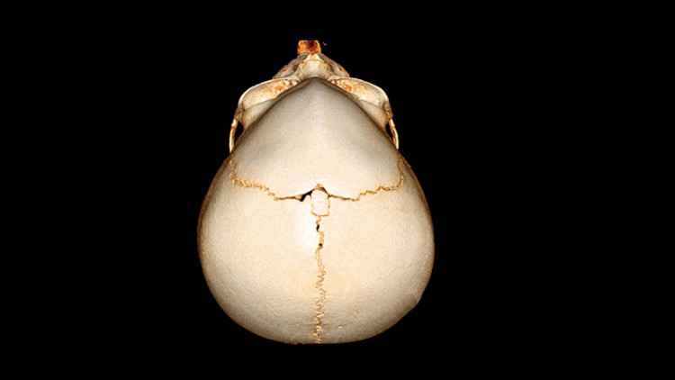 La sutura metopica è fisiologica tra 3 e 19 mesi: lo studio tedesco su Child’s Nervous System