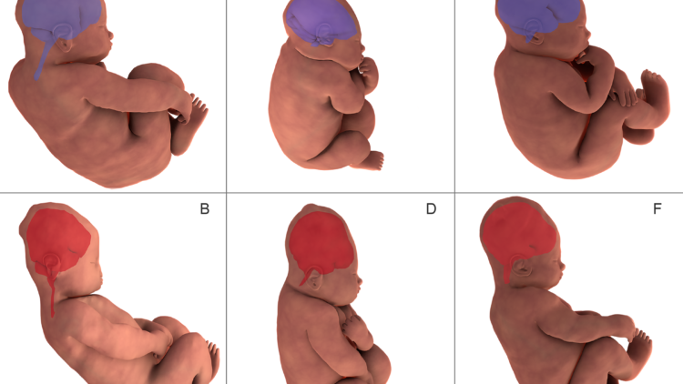 Parto e modellazione cranica del neonato: scoperto il momento esatto in cui il cranio si deforma