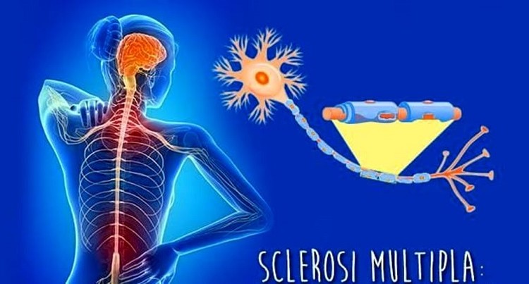 Osteopatia migliora i sintomi cronici nella Sclerosi Multipla: l’istituto IEMO promotore e garante dello studio pubblicato su JAOA