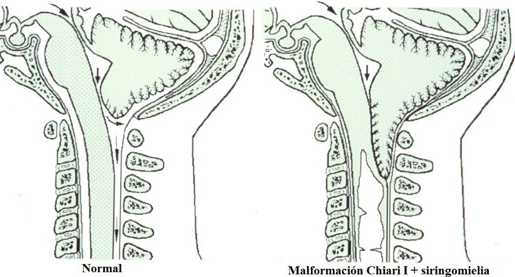 L’Osteopatia sentinella della Salute per l’intercettazione dell’anomalia di Chiari