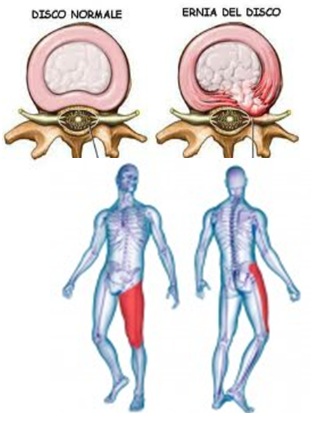 articulațiile lombare a osteochondrozei lombare