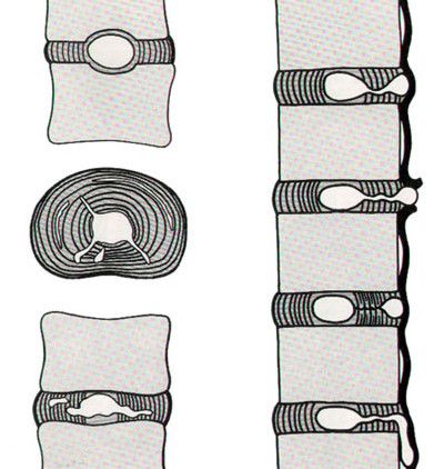 Lombalgie (mal di schiena)