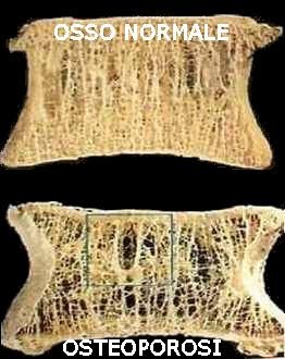 Osteoporosi