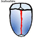 Scafocefalia