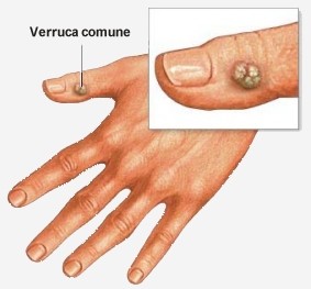 come eliminare papilloma virus verruche
